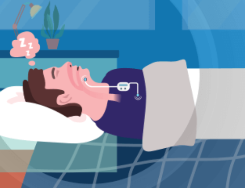 Upper Airway Stimulation for Obstructive Sleep Apnea
